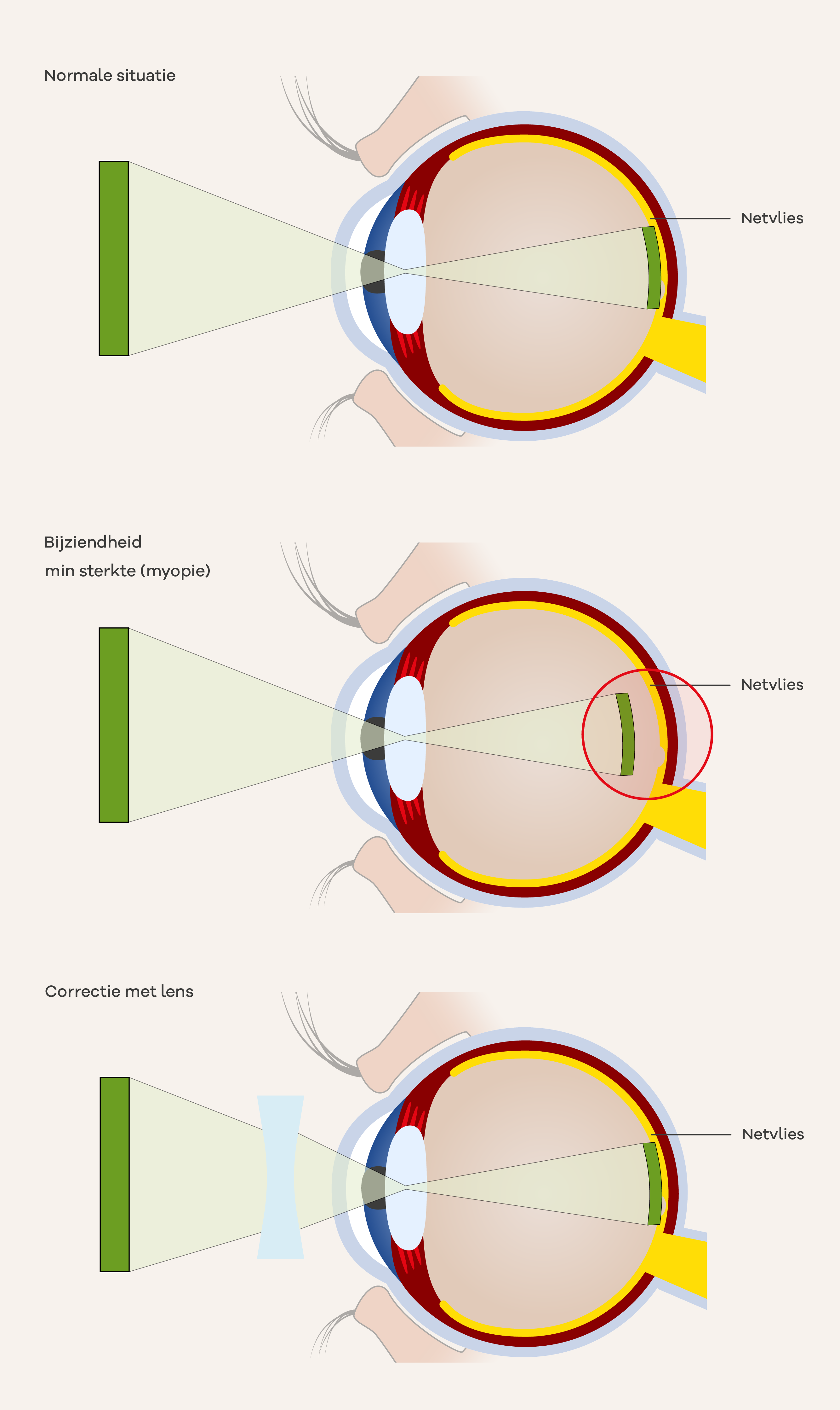 Illustratie van bijziendheid.