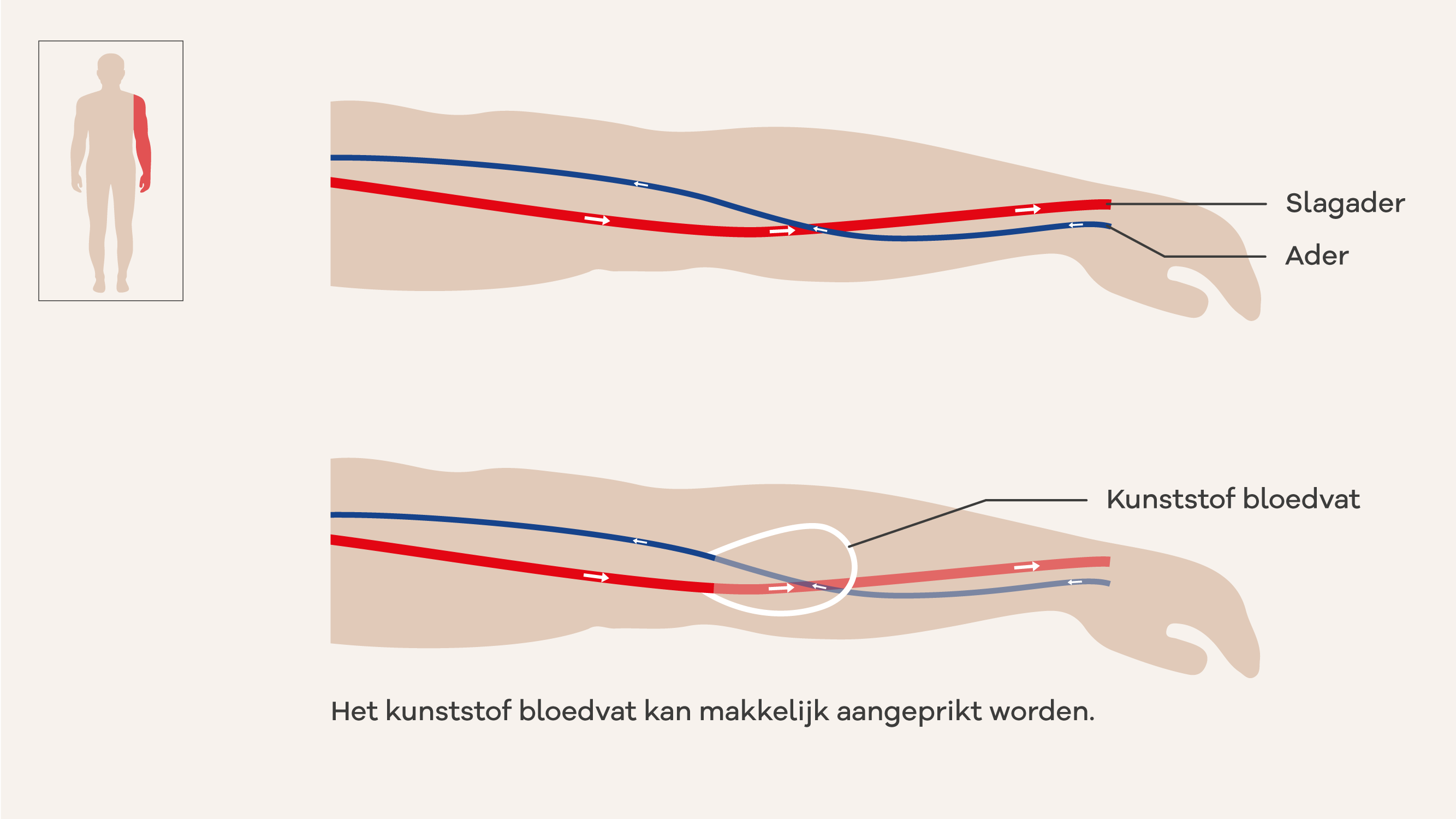 Illustratie van een shunt door een kunststof bloedvat. 